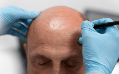 Alopecia Universalis: Ursachen, Symptome und Behandlungsoptionen